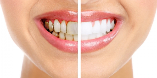 Налет на зубах: косметический недостаток или угроза здоровью?