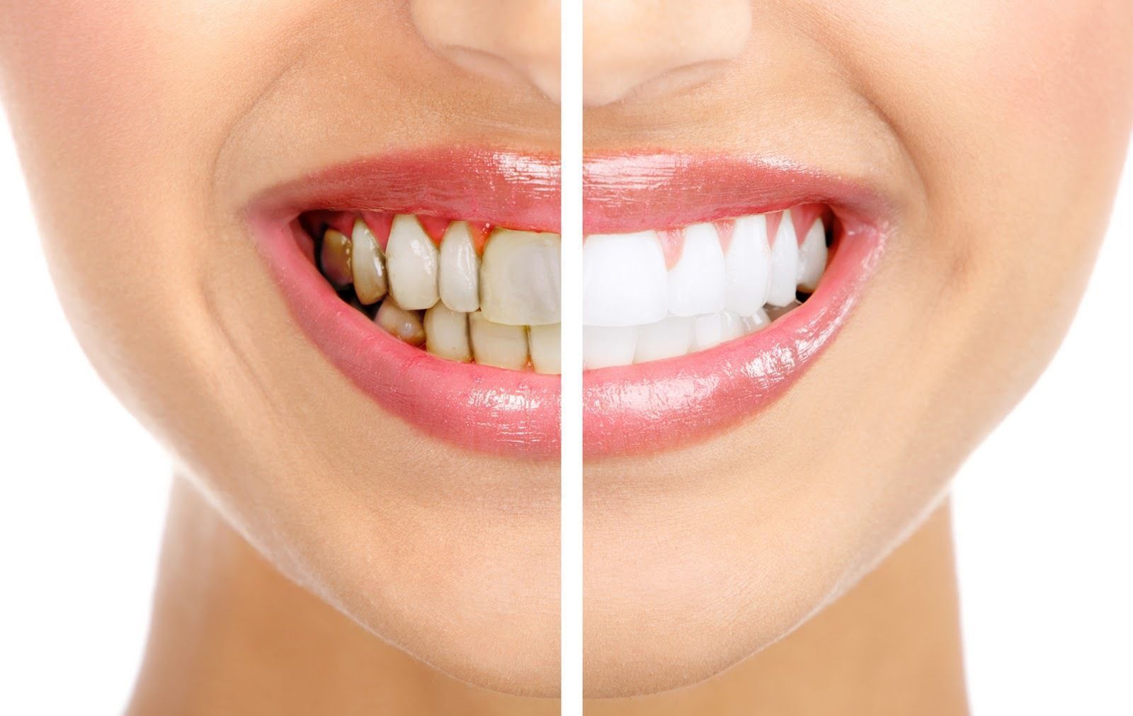 Налет на зубах: косметический недостаток или угроза здоровью?